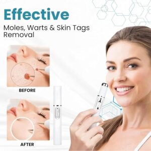 Mole & Wart Removal Pen – Painless Blue Light Therapy for Smooth Skin
